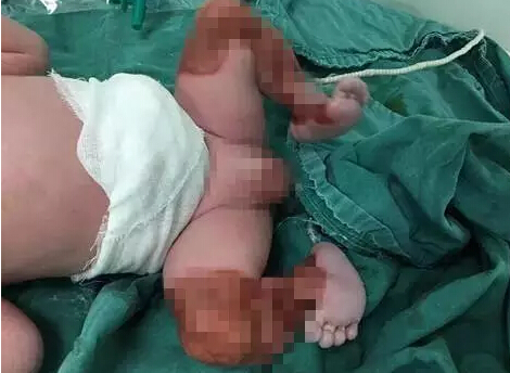 这名宝宝出生时“双腿透明”!这些东西孕期不能碰!