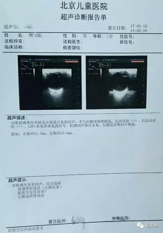 北京儿童医院超声诊断报告单显示:航航双眼球内异常回声,结合临床玻璃体轻混浊(左眼较重)等。