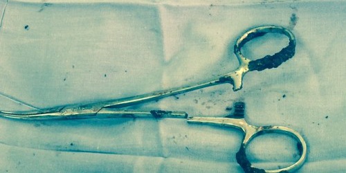 遗留在病人腹中的剪刀