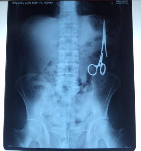 遗留在病人腹中的剪刀