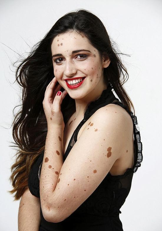 西班牙女孩全身长500枚胎记 被称“外星人”